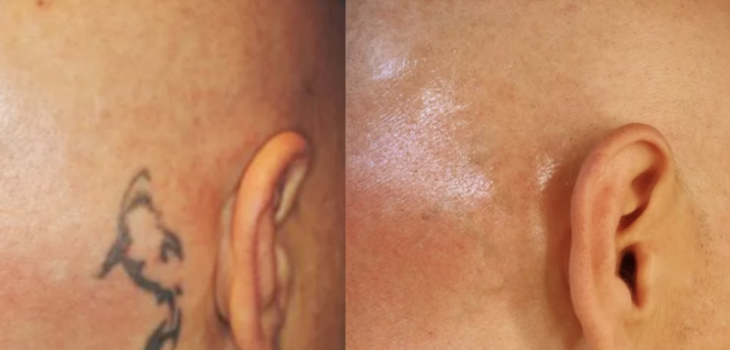 tattoo removal sydney